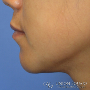 Ulthera Nonsurgical Lift