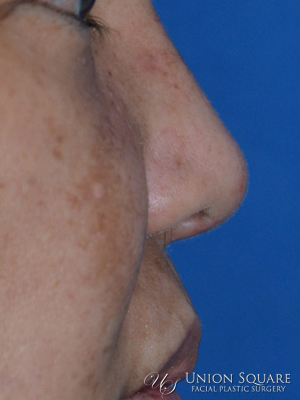 Non Surgical Rhinoplasty