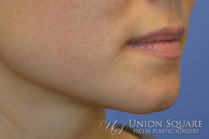 Chin Filler Augmentation