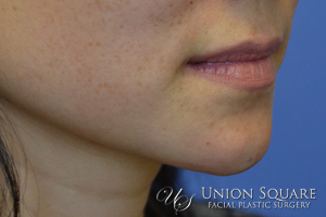 Chin Filler Augmentation