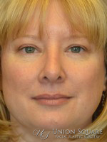 Brow Lift