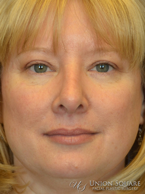 Brow Lift