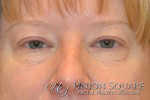 Blepharoplasty