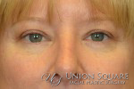 Blepharoplasty