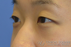 Asian Blepharoplasty / Creation of Double Lid Fold