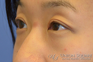 Asian Blepharoplasty / Creation of Double Lid Fold