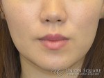 Jaw Slimming Botox