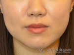 Jaw Slimming Botox