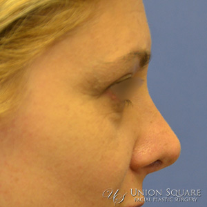 Rhinoplasty / Ethnic Rhinoplasty