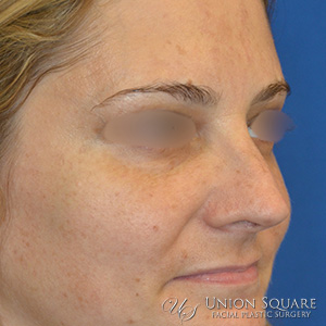 Rhinoplasty / Ethnic Rhinoplasty