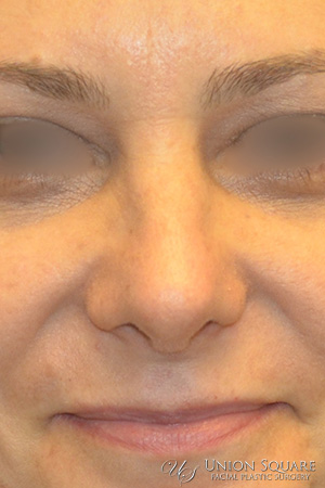 Rhinoplasty / Ethnic Rhinoplasty