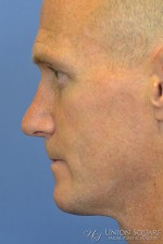 Rhinoplasty / Ethnic Rhinoplasty