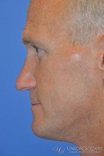 Rhinoplasty / Ethnic Rhinoplasty