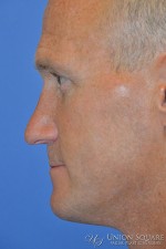 Rhinoplasty / Ethnic Rhinoplasty