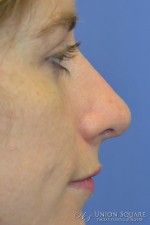 Non Surgical Rhinoplasty