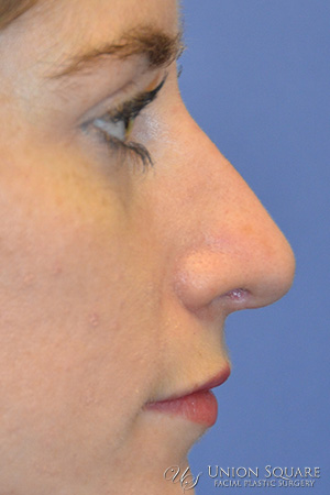 Non Surgical Rhinoplasty