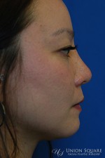 Non Surgical Rhinoplasty