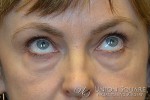 Blepharoplasty