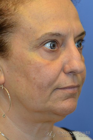 Rhinoplasty / Ethnic Rhinoplasty Case 3450 Before Photo Rhinoplasty / Ethnic Rhinoplasty