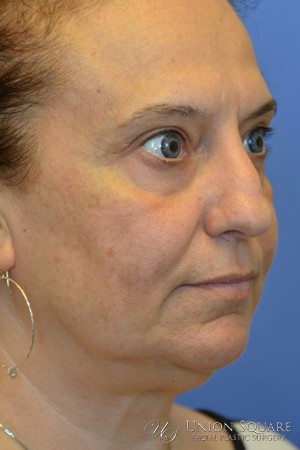 Rhinoplasty / Ethnic Rhinoplasty