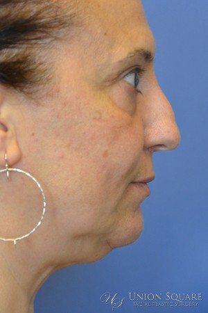 Rhinoplasty / Ethnic Rhinoplasty Case 3450 Before Photo Rhinoplasty / Ethnic Rhinoplasty