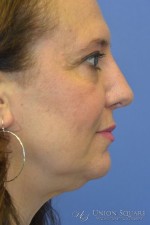 Rhinoplasty / Ethnic Rhinoplasty