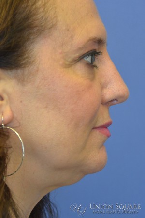 Rhinoplasty / Ethnic Rhinoplasty Case 3450 After Photo Rhinoplasty / Ethnic Rhinoplasty