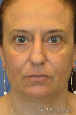 Rhinoplasty / Ethnic Rhinoplasty Case 3450 Before Photo Rhinoplasty / Ethnic Rhinoplasty