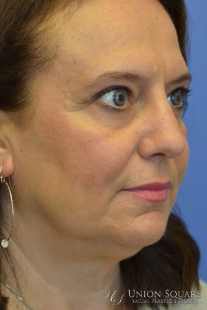 Rhinoplasty / Ethnic Rhinoplasty Case 3450 After Photo Rhinoplasty / Ethnic Rhinoplasty