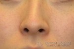 Rhinoplasty / Ethnic Rhinoplasty