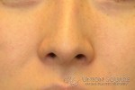 Rhinoplasty / Ethnic Rhinoplasty