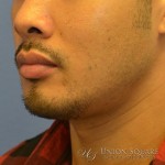 Chin Filler Augmentation