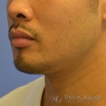 Chin Filler Augmentation