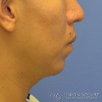 Chin Filler Augmentation