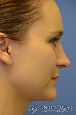 Rhinoplasty / Ethnic Rhinoplasty