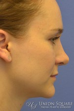 Rhinoplasty / Ethnic Rhinoplasty