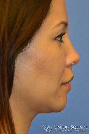 Non Surgical Rhinoplasty