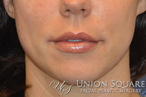 Lip Enhancement