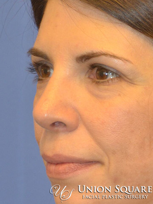 Rhinoplasty / Ethnic Rhinoplasty