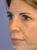 Rhinoplasty / Ethnic Rhinoplasty