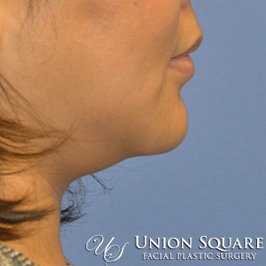 Chin / Neck Liposuction