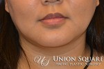 Chin / Neck Liposuction