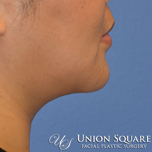 Chin / Neck Liposuction