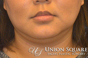 Chin / Neck Liposuction