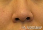 Mole Removal