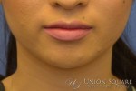 Facial Contouring with Fillers