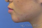 Facial Contouring with Fillers