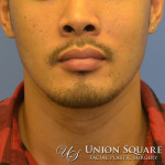 Rhinoplasty / Ethnic Rhinoplasty