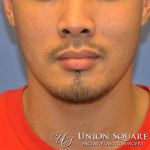 Rhinoplasty / Ethnic Rhinoplasty