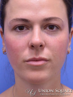 Facial Contouring with Fillers